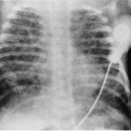Epidemiology of Bronchopulmonary Dysplasia Banner